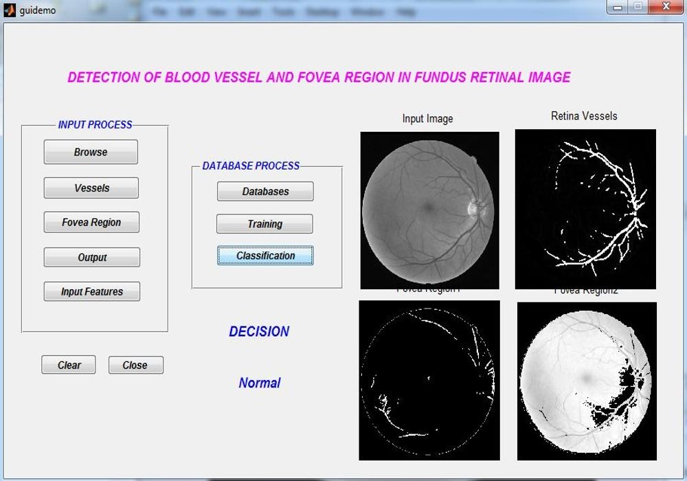 Blood Vessel Segmentation in Retinal Images using Matlab
