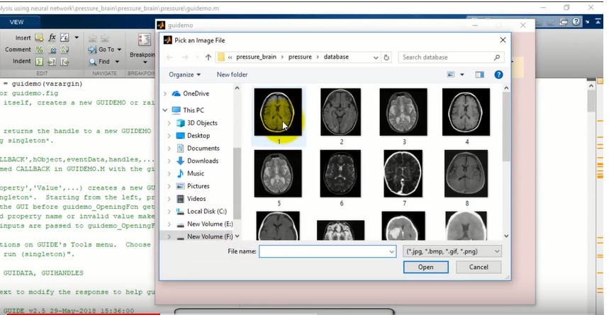 Brain Pressure Analysis using Neural Networks