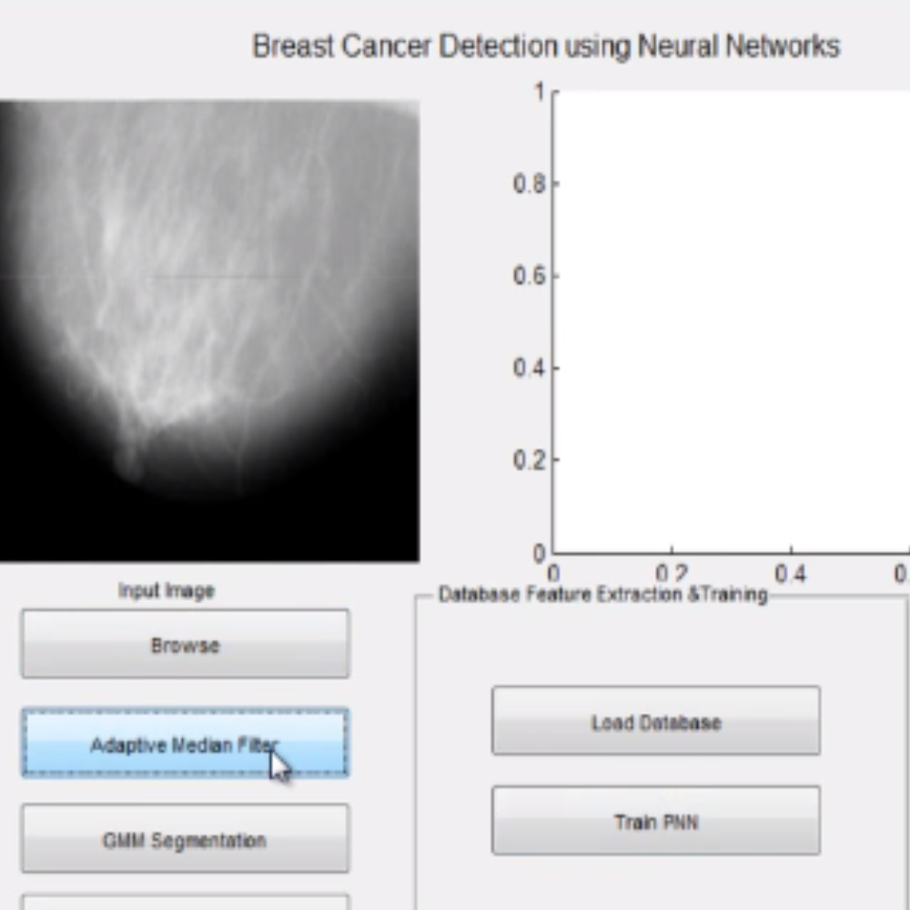 Breast Cancer Detection using Neural Networks