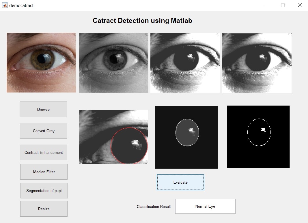 Automatic Eye Cataract Detection Algorithm Using MATLAB