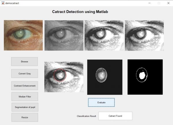 cataract detection using matlab