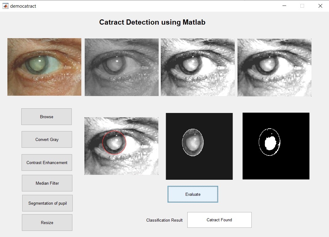 Automatic Eye Cataract Detection Algorithm Using MATLAB