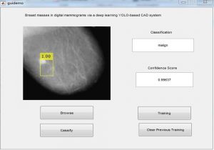 Breast Masses Detection using Deep Learning (Yolo Algorithm)