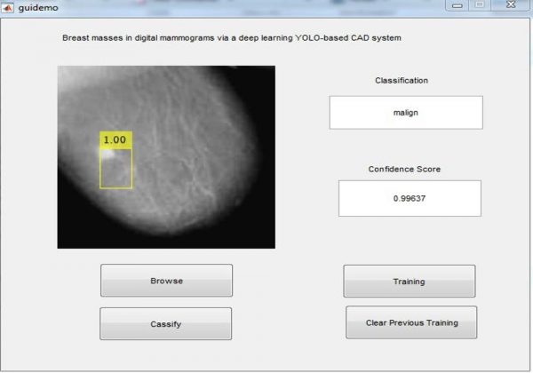 breast cancer detection using deep learning
