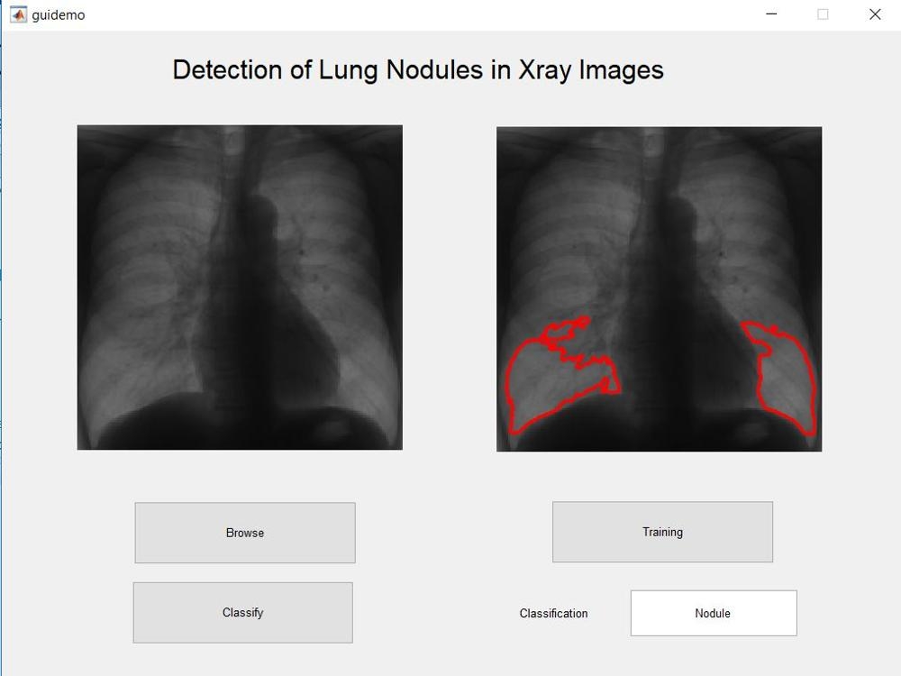 Lung Nodule Detection in Xray Images using CNN