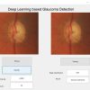 Glaucoma detection using Deep Learning