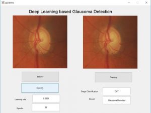 Glaucoma Detection using Deep Learning