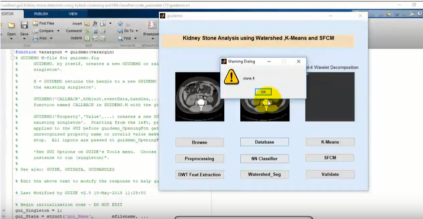 Kidney Stone Analysis using Matlab