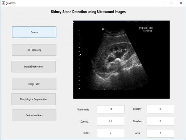 kidney stone detection using Image Processing
