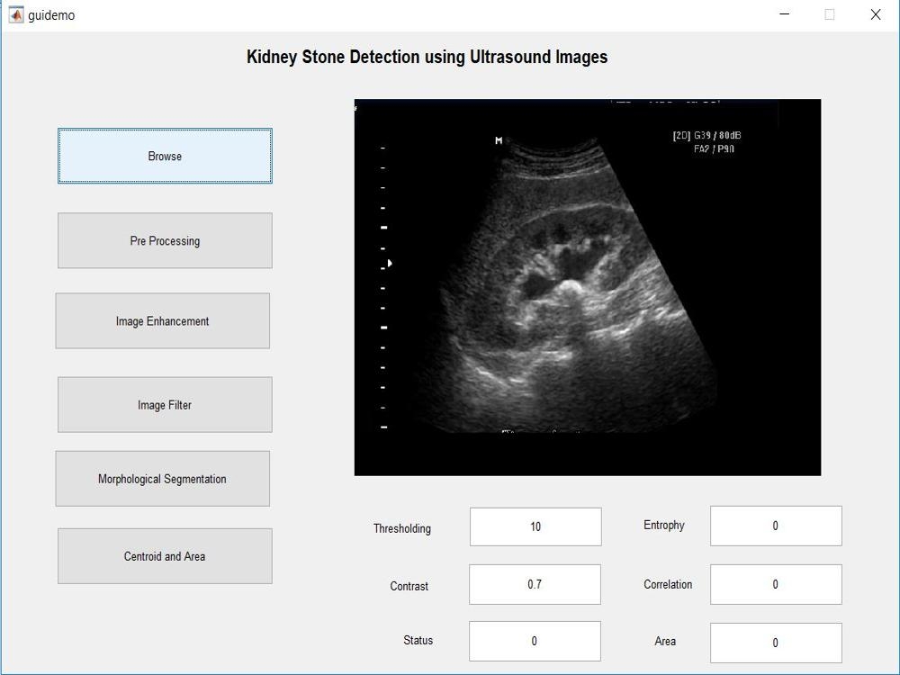Kidney stone detection using Matlab – Image Processing Project
