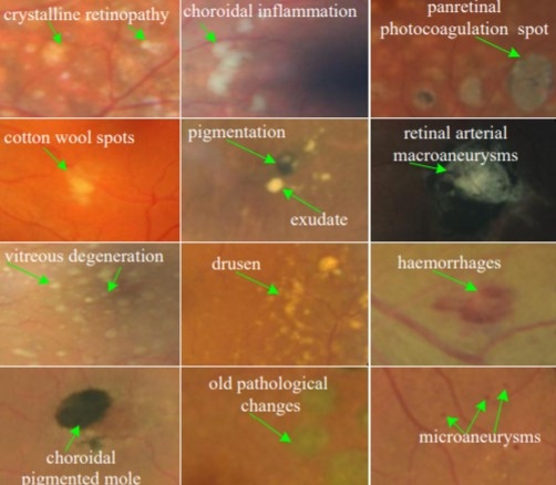 Lesion Detection from Fundus Images using Deep Learning