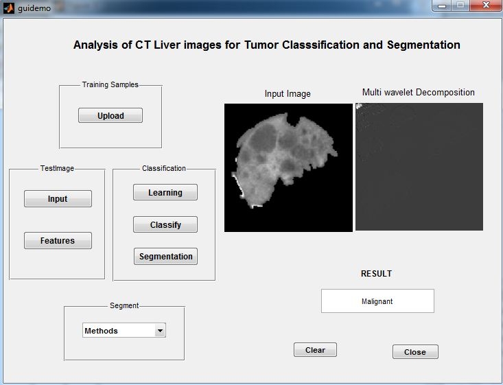 Liver Tumor Detection using Matlab