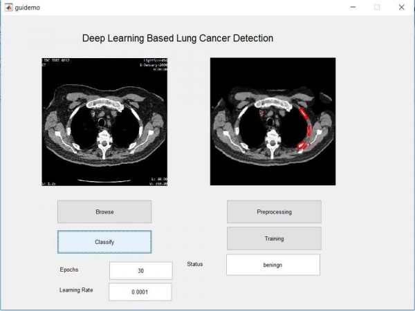 lung cancer detection using deep learning