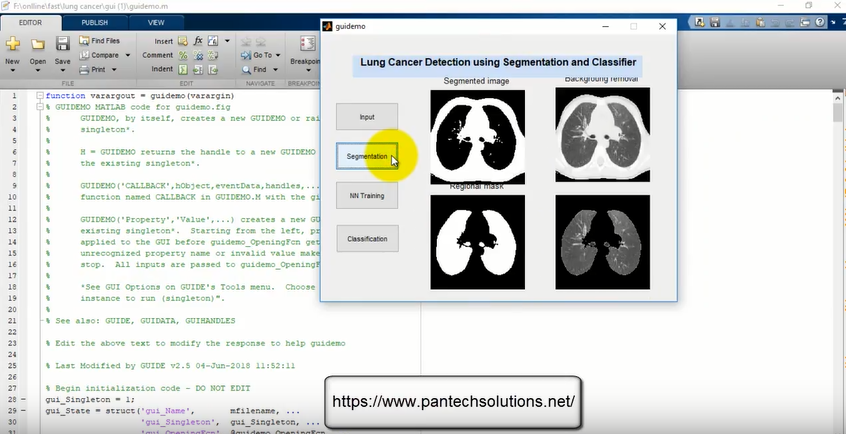 Lung Cancer Detection using Matlab