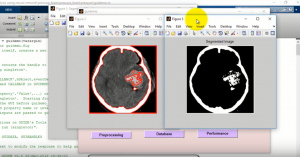 Brain Pressure Analysis using Neural Networks