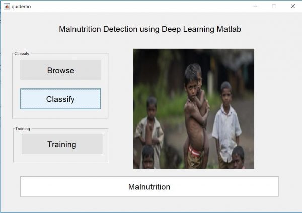 Malnutrition Detection using Deep Learning