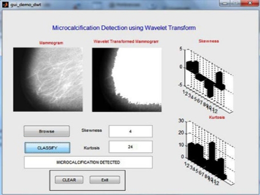 Matlab code for Detection of Microcalcification