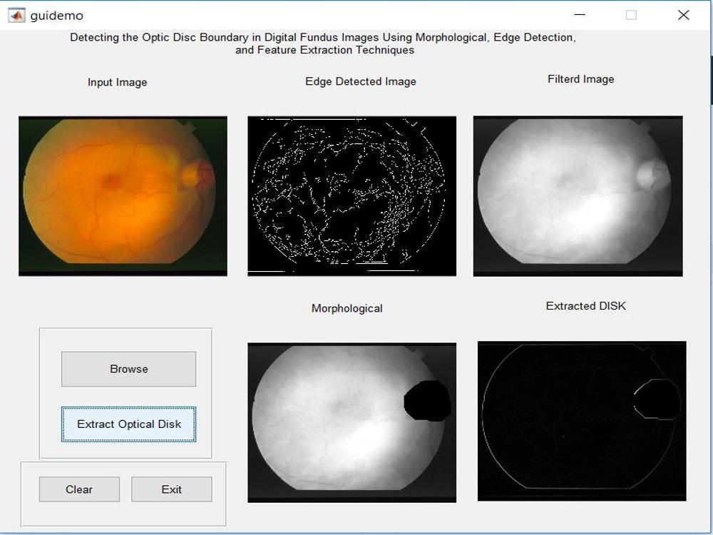 Matlab code for optic disk detection in Diabetic retinopathy
