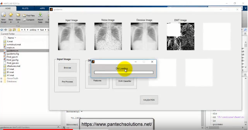 Tuberculosis Detection in XRAY Images using Matlab -Image Processing Project