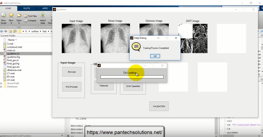 Tuberculosis Detection in XRAY Images using Matlab -Image Processing Project