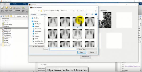 Tuberculosis Detection in XRAY Images using Matlab
