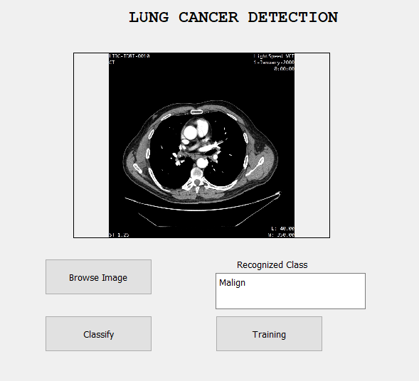 Lung Cancer Detection using Deep learning