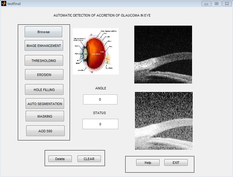 MATLAB CODE FOR GLAUCOMA DETECTION