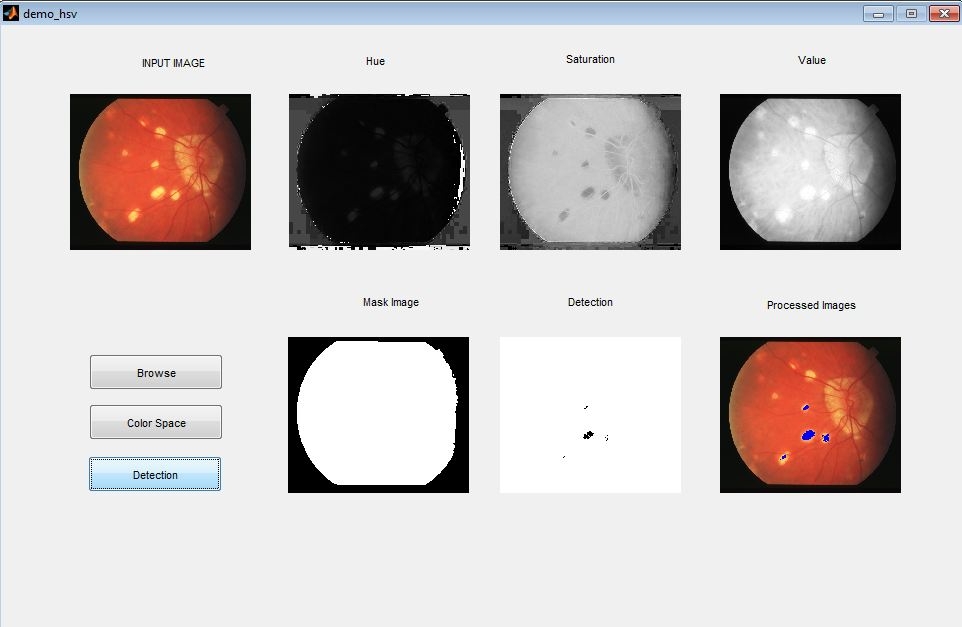 matlab code for diabetic retinopathy