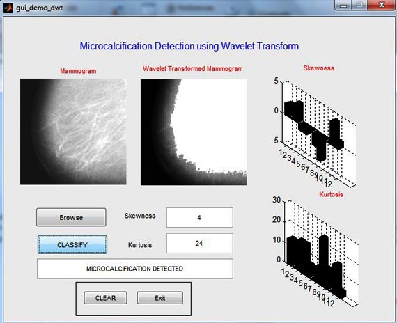 microcalcification-detection-using-wavelet-transform
